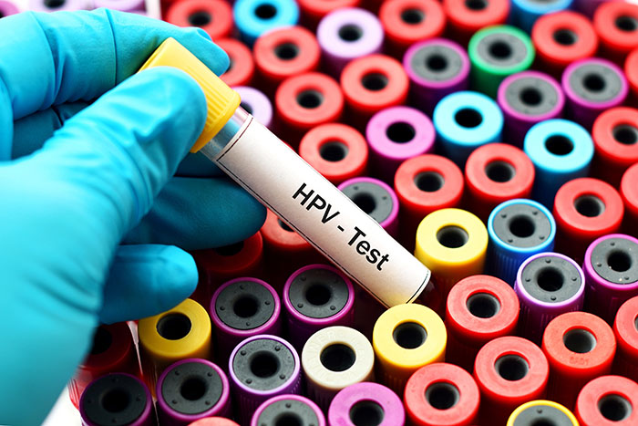El VPH representa el cuarto cáncer más frecuente en el mundo