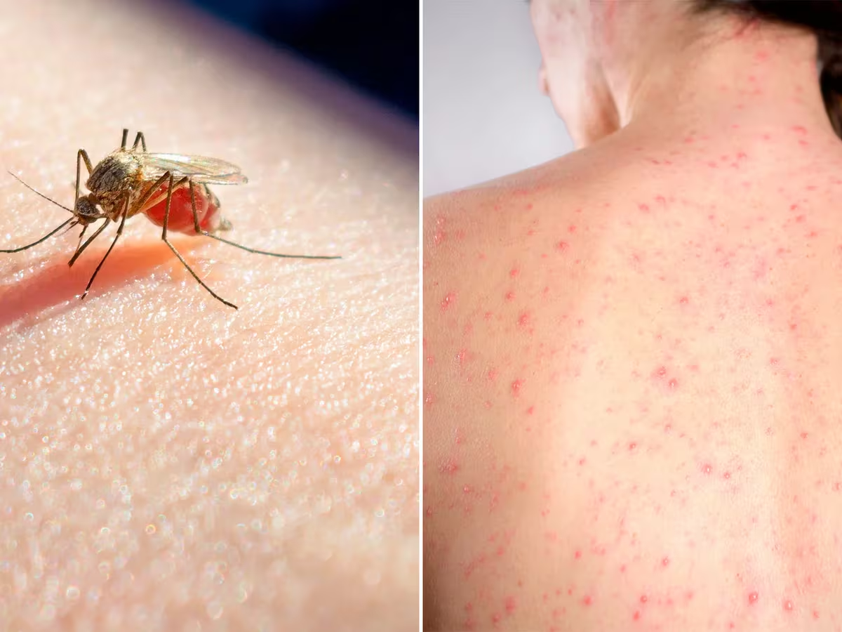 Alerta en las Américas por aumento de Casos de Dengue y Sarampión